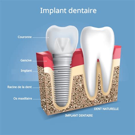 implant dentaire c'est quoi.